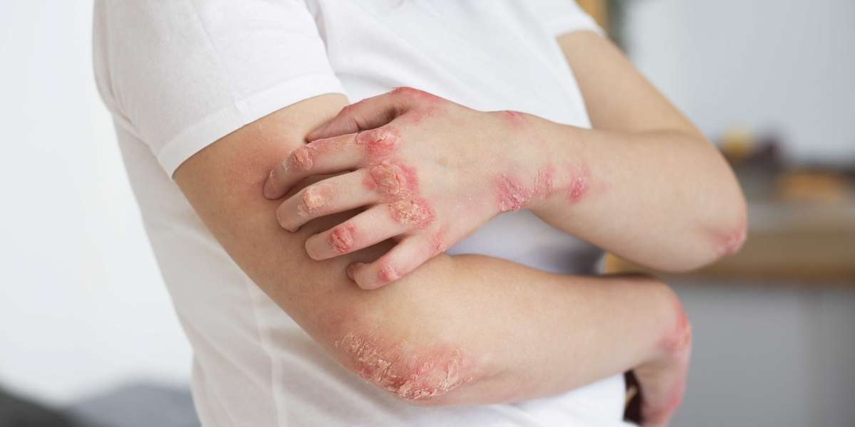 Why Ivermectin 3mg is a Trusted Choice for Parasitic Infection Treatment?